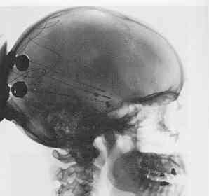 Skull xray with electrodes